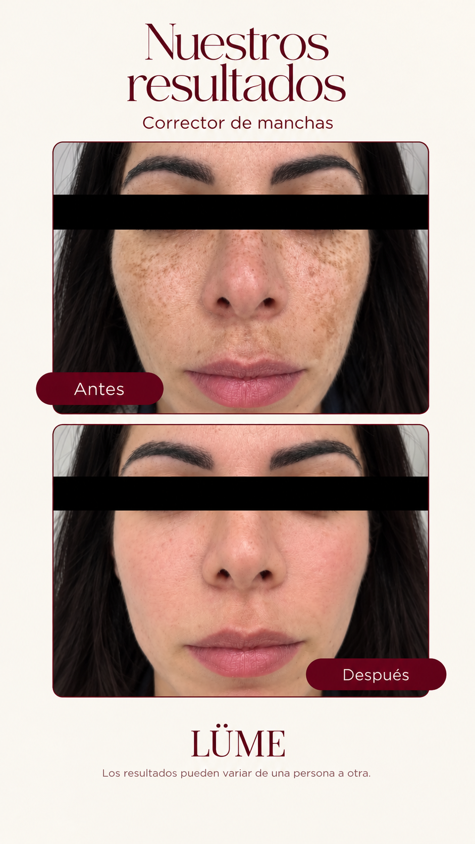 Melasma en el rostro
